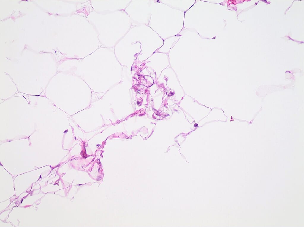 Adipose tissue with crumpling artifact due to insufficient fixation | オンザショア立川店 立川駅徒歩1分年中無休の溶岩ホットヨガスタジオ 顕微鏡で拡大した脂肪組織の標本脂肪をためる細胞が並び一部にしわが寄っている 立川駅徒歩1分年中無休の溶岩ホットヨガスタジオ