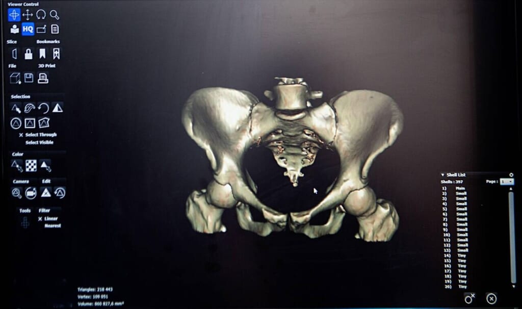 3D Computed Tomography CT Reconstruction of the Human Pelvis and Hip Orthopedic View | オンザショア立川店 立川駅徒歩1分年中無休の溶岩ホットヨガスタジオ 骨盤と左右の股関節の骨の形状を立体的に示したCT画像の三次元再構成 立川駅徒歩1分年中無休の溶岩ホットヨガスタジオ