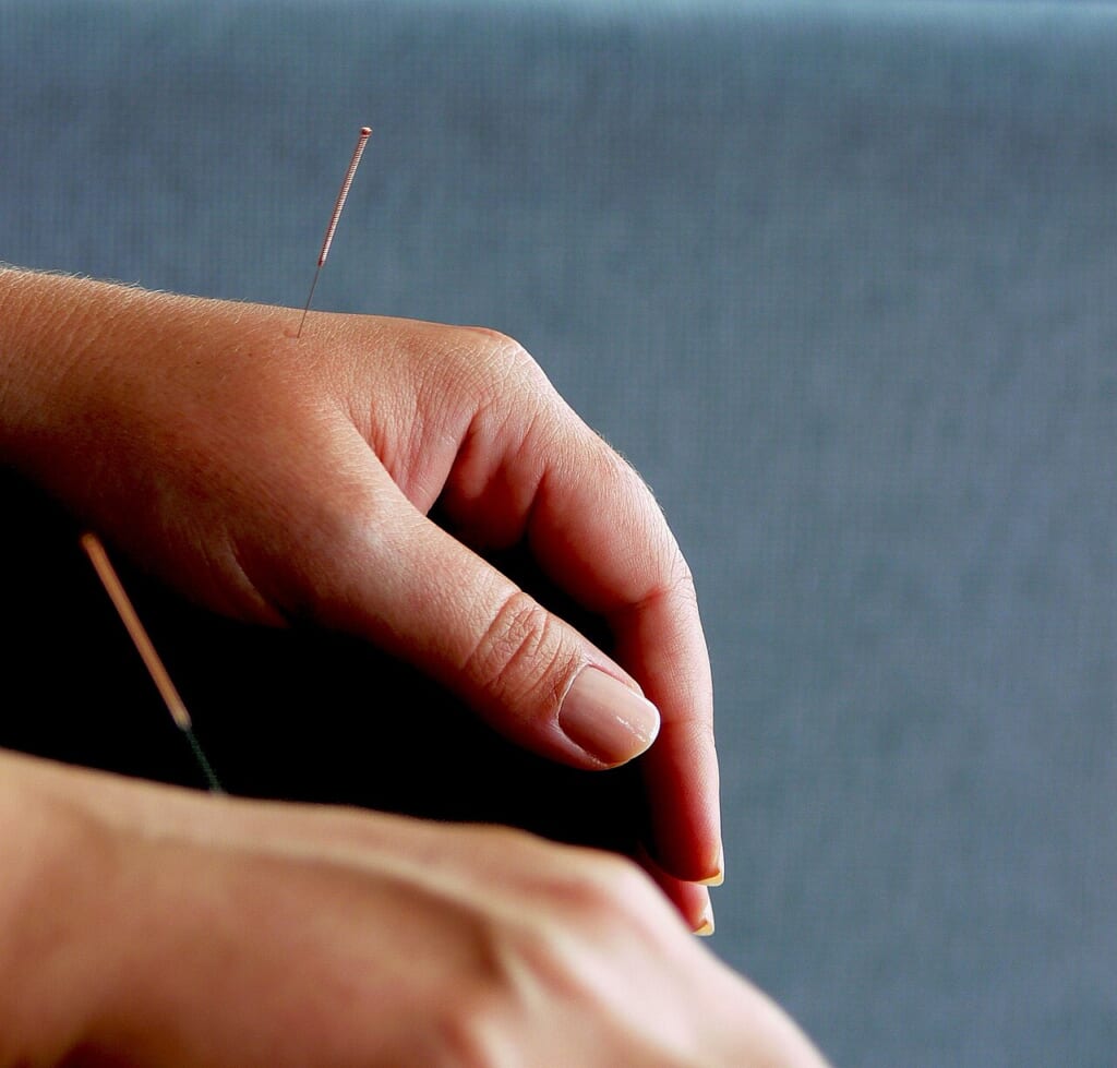 Acupuncture 812874290 | オンザショア立川店 立川駅徒歩1分年中無休の溶岩ホットヨガスタジオ 鍼が刺さった左右の手を写した写真手元にある鍼の様子が見える 立川駅徒歩1分年中無休の溶岩ホットヨガスタジオ