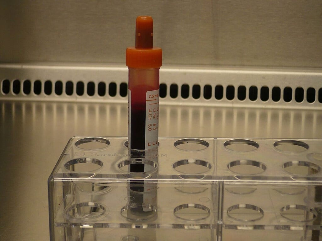 Tube with blood sample | オンザショア立川店 立川駅徒歩1分年中無休の溶岩ホットヨガスタジオ 採取された血液の検体が入った管血液を調べるための検体を入れた容器 立川駅徒歩1分年中無休の溶岩ホットヨガスタジオ